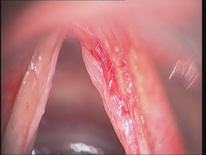 Fotos clínicas: Microcirugía endolaríngea. Mucosa plano glótico